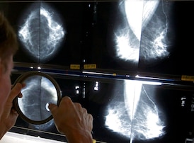 Black women face up to 70 per cent higher breast cancer mortality, study finds