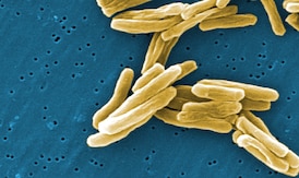 Saskatchewan has some of the highest tuberculosis rates in the country. Here’s what to know